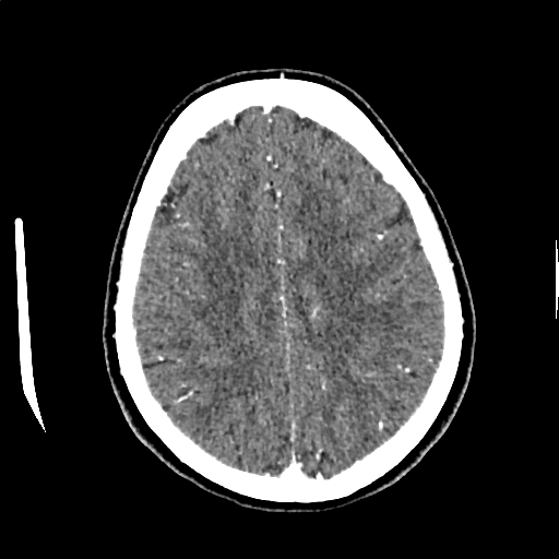 Calcified cerebral hydatid cyst (Radiopaedia 65603-74717 Axial with contrast 57).jpg