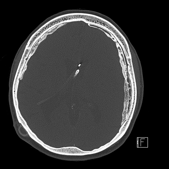 Calcified chronic subdural hematoma (Radiopaedia 77374-89492 Axial bone window 76).jpg