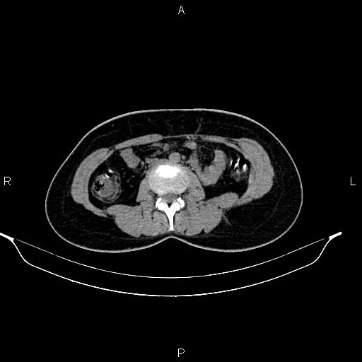 File:Calcified hepatic hydatid cyst (Radiopaedia 84672-100095 Axial non-contrast 59).jpg