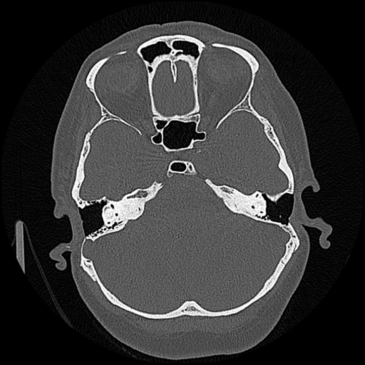 Canal up mastoidectomy (Radiopaedia 78108-90638 Axial bone window 90).jpg