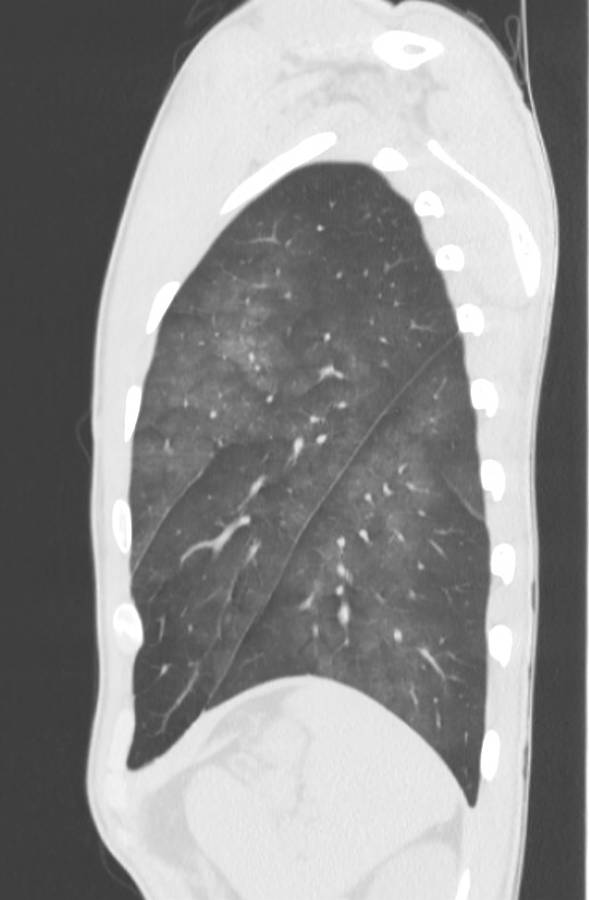 Cannabis-induced diffuse alveolar hemorrhage (Radiopaedia 89834-106946 Sagittal lung window 116).jpg