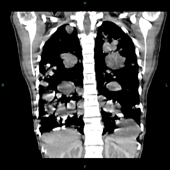 File:Cannon ball metastases - synovial sarcoma (Radiopaedia 26135-26271 Coronal liver window 15).jpg