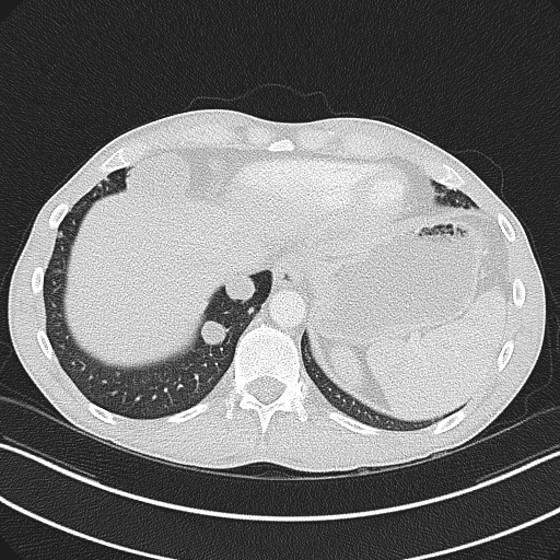 Cannonball metastases - testicular choriocarcinoma (Radiopaedia 84510-99891 Axial lung window 81).jpg
