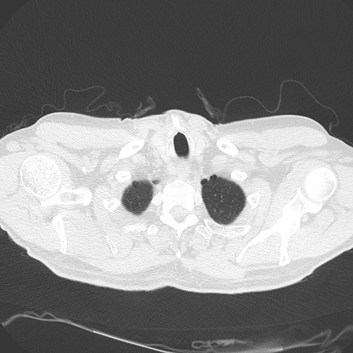 Caplan syndrome (Radiopaedia 56667-63530 Axial lung window 20).jpg