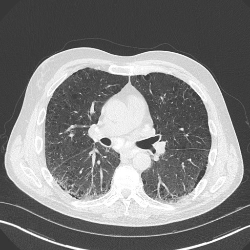 Caplan syndrome (Radiopaedia 56667-63530 Axial lung window 99).jpg