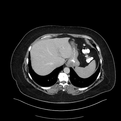 Carcinoid tumor - terminal ileum (Radiopaedia 60931-68739 A 22).jpg