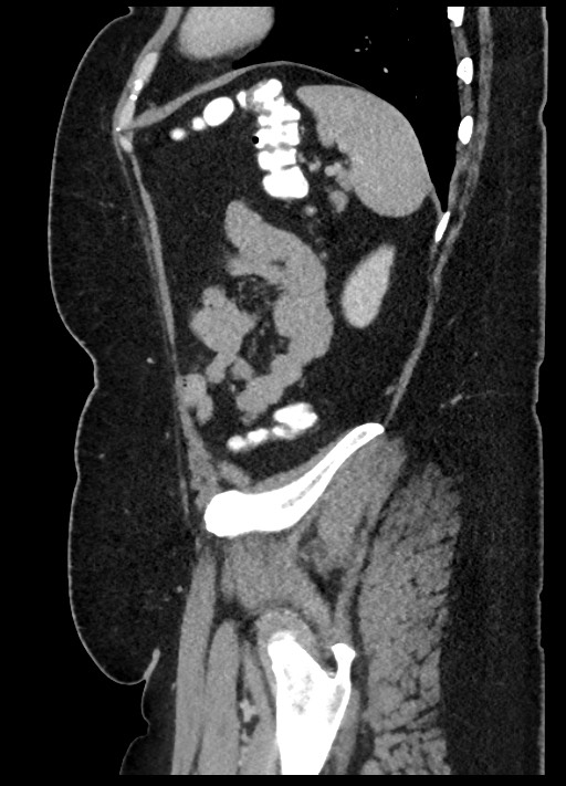 Carcinoid tumor - terminal ileum (Radiopaedia 60931-68739 C 13).jpg