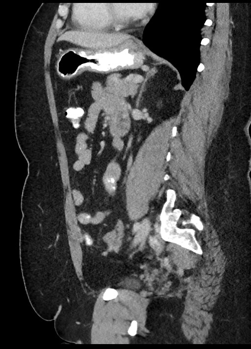 Carcinoid tumor - terminal ileum (Radiopaedia 60931-68739 C 35).jpg