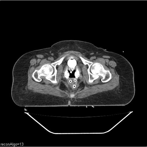 File:Carcinoma cervix- brachytherapy applicator (Radiopaedia 33135-34173 Axial non-contrast 37).jpg