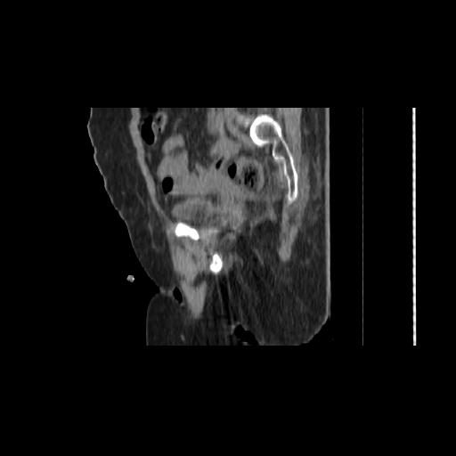 File:Carcinoma cervix- brachytherapy applicator (Radiopaedia 33135-34173 D 60).jpg
