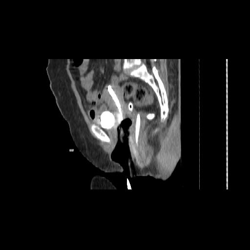File:Carcinoma cervix- brachytherapy applicator (Radiopaedia 33135-34173 D 84).jpg
