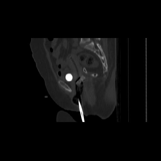File:Carcinoma cervix- brachytherapy applicator (Radiopaedia 33135-34173 Sagittal bone window 80).jpg