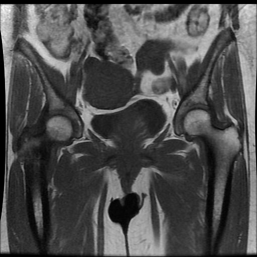 File:Carcinoma of the cervix (Radiopaedia 89018-105858 Coronal T1 6).jpg
