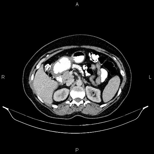 Carcinoma of uterine cervix (Radiopaedia 85861-101700 A 40).jpg