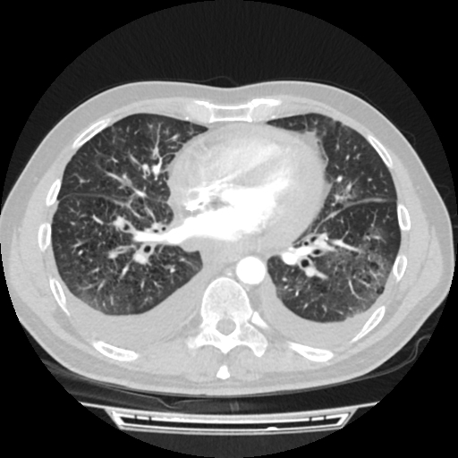 Cardiac tamponade (Radiopaedia 78607-91368 Axial lung window 53).jpg