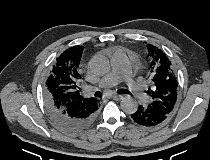 Cardiogenic pulmonary edema (Radiopaedia 68180-77678 Axial non-contrast 19).jpg