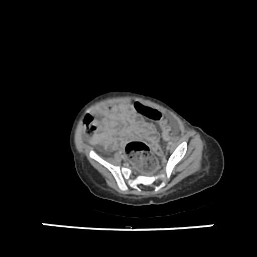 File:Caroli disease with autosomal recessive polycystic kidney disease (ARPKD) (Radiopaedia 89651-106703 B 186).jpg