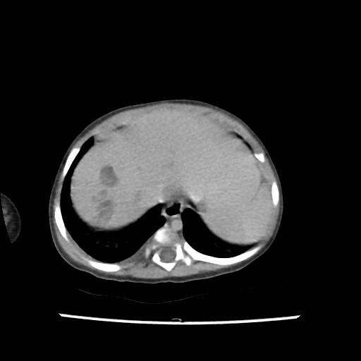 Caroli disease with autosomal recessive polycystic kidney disease (ARPKD) (Radiopaedia 89651-106703 B 22).jpg