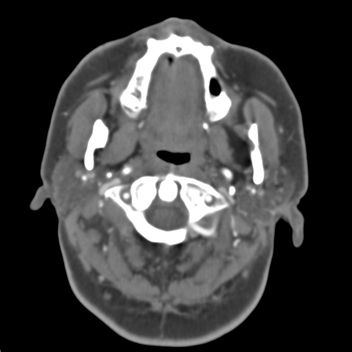 Carotico ophthalmic aneurysm (Radiopaedia 42916-46148 A 52).png