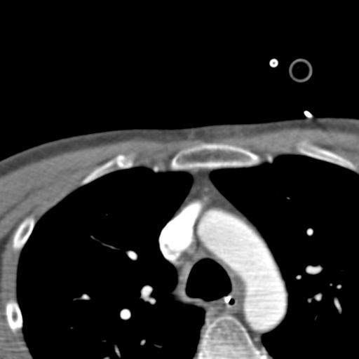 File:Carotid arterial dissection (Radiopaedia 30001-30548 B 4).jpg