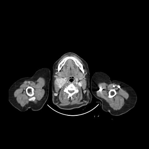 File:Carotid body tumor (Radiopaedia 21021-20948 B 14).jpg