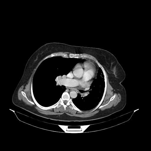 File:Carotid body tumor (Radiopaedia 21021-20948 B 40).jpg