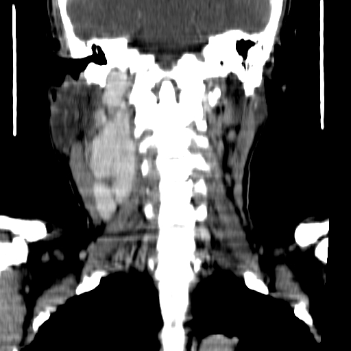 File:Carotid body tumor (Radiopaedia 27890-28124 B 6).jpg