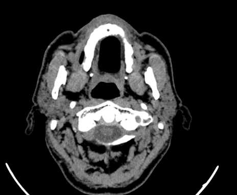 Carotid body tumor (Radiopaedia 61750-69757 Axial non-contrast 11).jpg