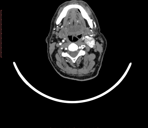 Carotid body tumor (Radiopaedia 66785-76116 B 33).jpg