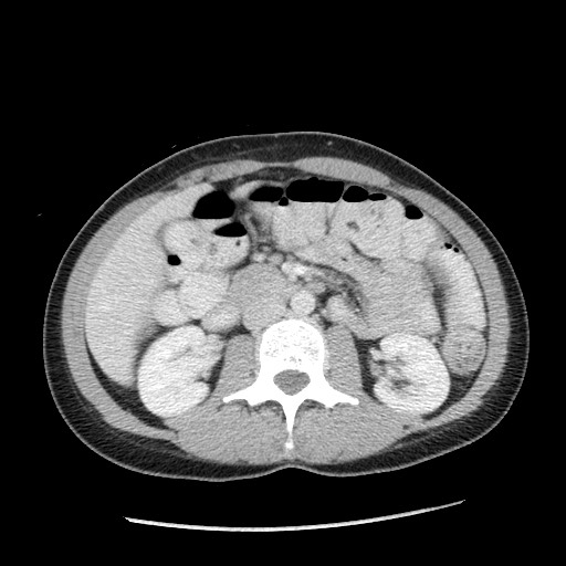 Castleman disease with fibrous pseudotumor in the abdomen (Radiopaedia 77296-89373 A 54).jpg
