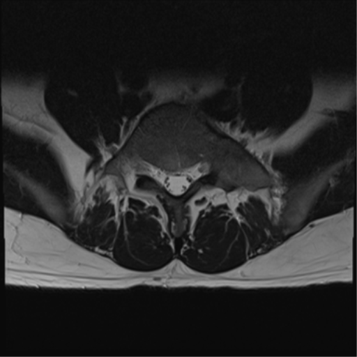 File:Cauda equina syndrome (Radiopaedia 53615-59672 Axial T2 9).png
