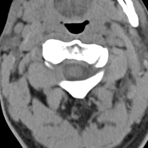 File:Cavernoma of cervical cord (Radiopaedia 50838-56346 Coronal non-contrast 2).png