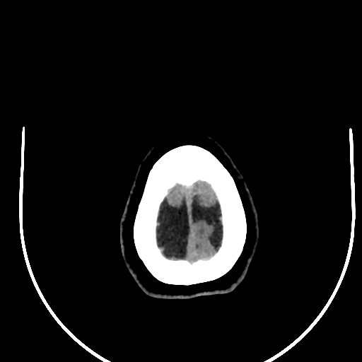 Cavernous hemangioma of the cerebellar falx (Radiopaedia 73025-83723 Axial non-contrast 132).jpg