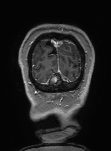 Cavernous hemangioma of the cerebellar falx (Radiopaedia 73025-83724 Coronal T1 C+ 351).jpg