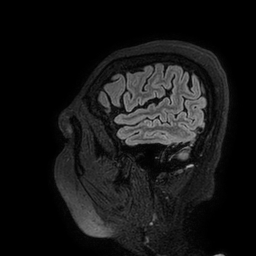 File:Cavernous hemangioma of the cerebellar falx (Radiopaedia 73025-83724 Sagittal FLAIR 195).jpg