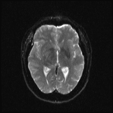 Cavernous sinus meningioma (Radiopaedia 63682-72367 DWI 12).jpg