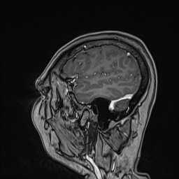 Cavernous sinus meningioma (Radiopaedia 63682-72367 Sagittal T1 C+ 139).jpg