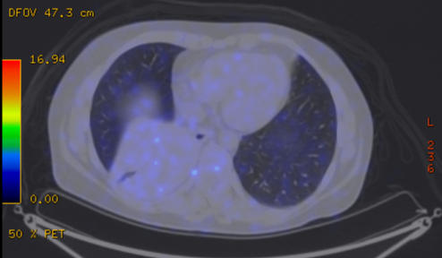 File:Cavitating lung mass - squamous cell carcinoma (Radiopaedia 48047-52853 A 63).png