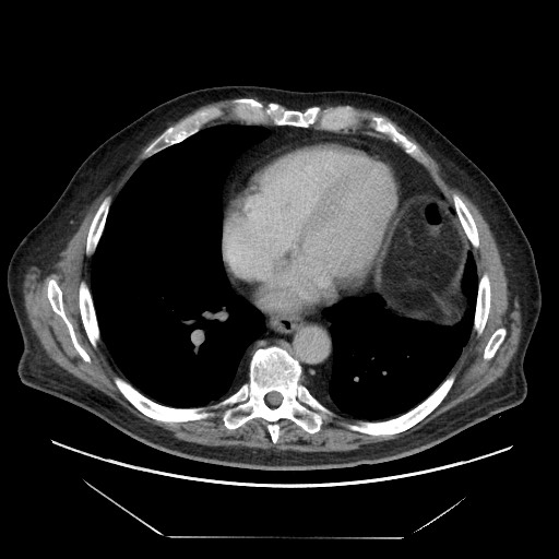 Cecal adenocarcinoma (Radiopaedia 64871-73817 A 2).jpg