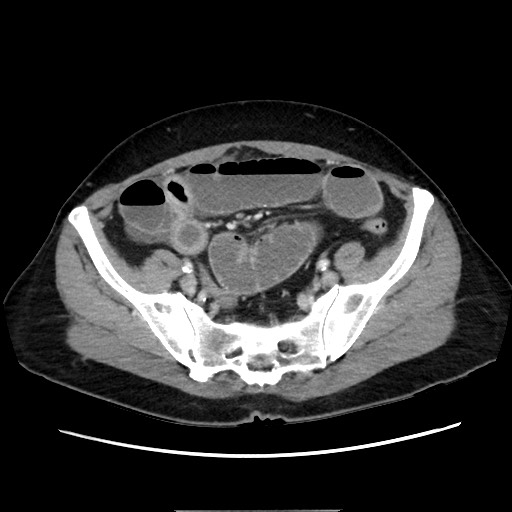 Cecal adenocarcinoma (Radiopaedia 75909-87331 A 69).jpg
