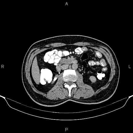 Cecal adenocarcinoma (Radiopaedia 85324-100916 Axial C+ delayed 44).jpg