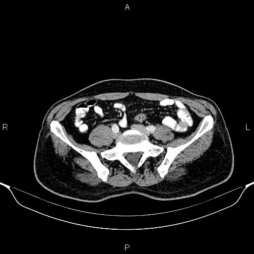 File:Cecal adenocarcinoma (Radiopaedia 85324-100916 B 68).jpg