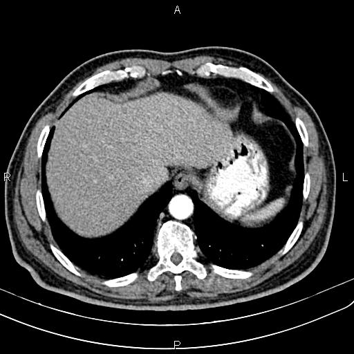 Cecal cancer with appendiceal mucocele (Radiopaedia 91080-108651 A 54).jpg