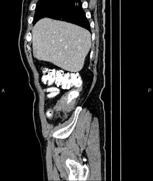 File:Cecal cancer with appendiceal mucocele (Radiopaedia 91080-108651 E 15).jpg