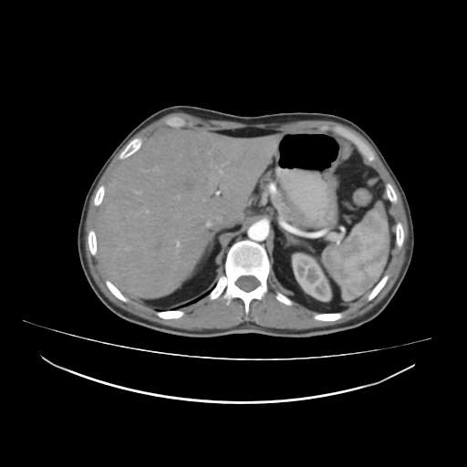 Cecal carcinoma with local lymphadenopathy (Radiopaedia 31428-32240 A 9).jpg