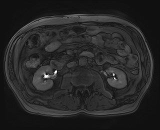 Cecal mass causing appendicitis (Radiopaedia 59207-66532 K 64).jpg