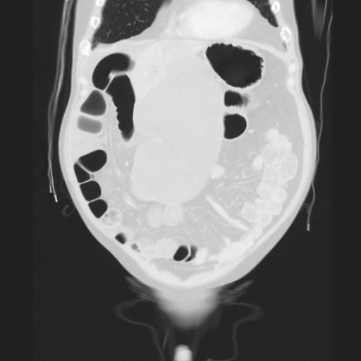 Cecal volvulus (Radiopaedia 75378-86620 Coronal lung window 45).jpg