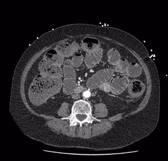 Celiac artery severe stenosis and dissection (Radiopaedia 44128-47842 B 54).jpg