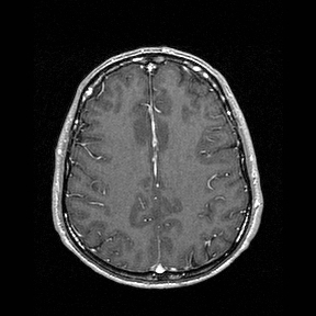 Central-variant posterior reversible encephalopathy syndrome (PRES) (Radiopaedia 43880-47358 Axial T1 C+ 117).jpg