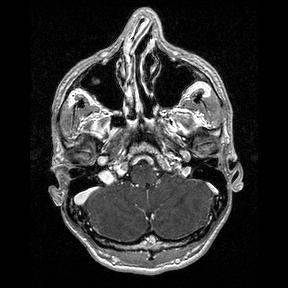 File:Central-variant posterior reversible encephalopathy syndrome (PRES) (Radiopaedia 43880-47358 Axial T1 C+ 20).jpg
